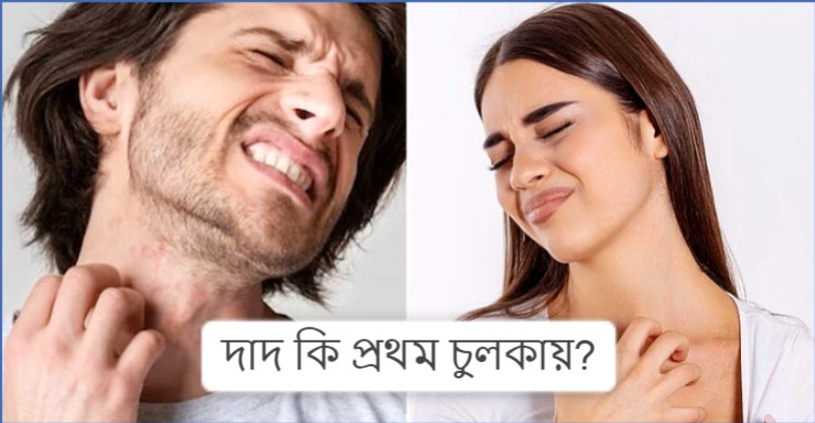 দাদ কি প্রথম চুলকায়?