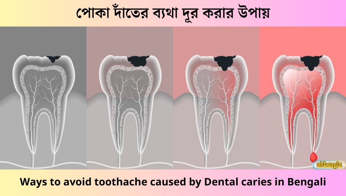 পোকা দাঁতের ব্যথা দূর করার উপায়