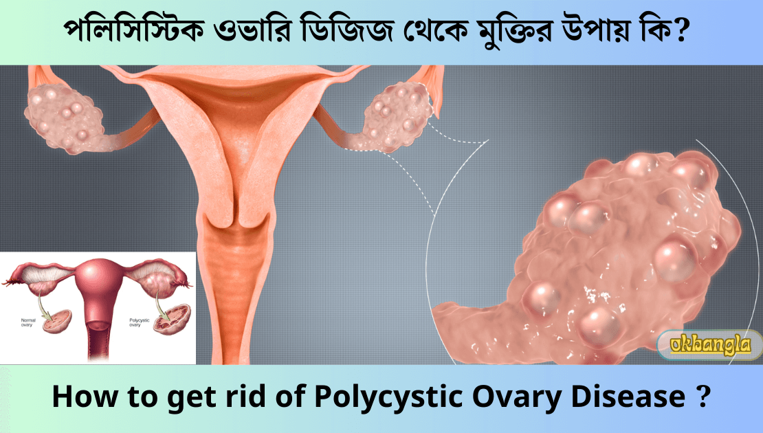 পলিসিস্টিক ওভারি ডিজিজ থেকে মুক্তির উপায়