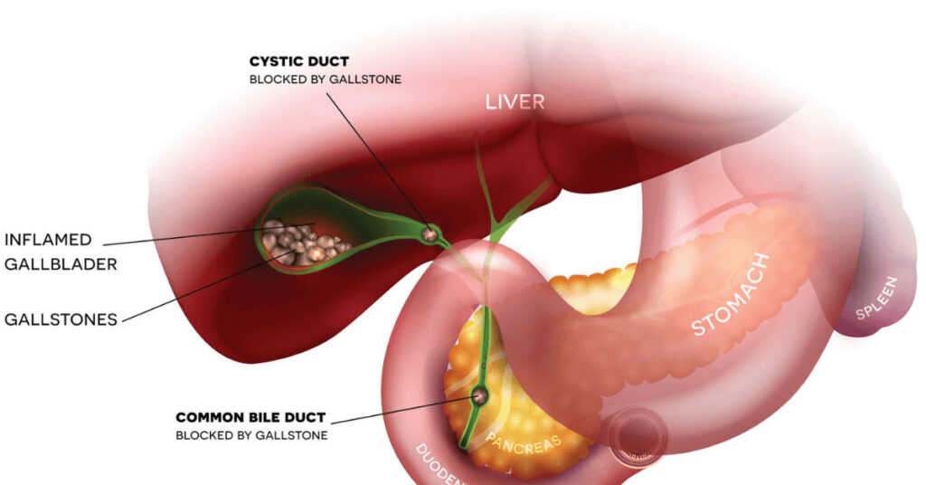 Reasons For Stones To Happen in Body