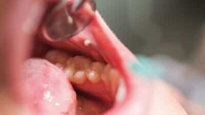 হিউম্যান প্যাপিলোমাভাইরাস (HPV)