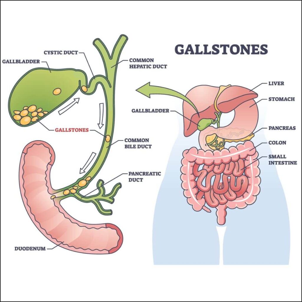 Why Stones Occur In Human Body Explained In Bengali